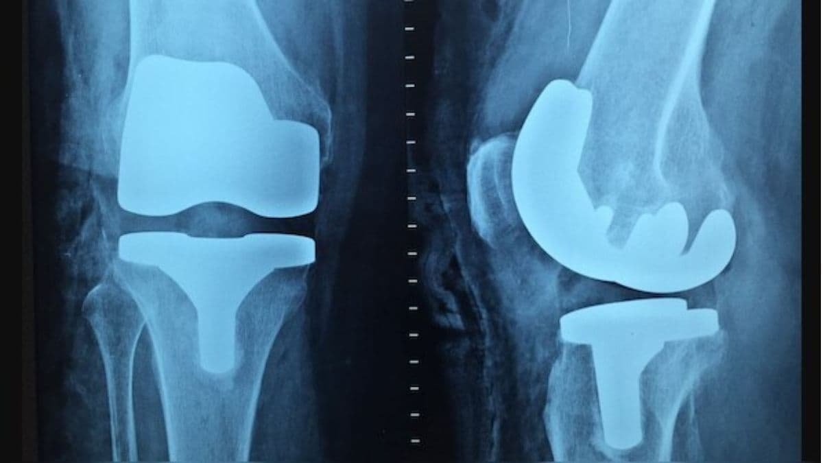 Why women face double the risk of osteoporosis compared to