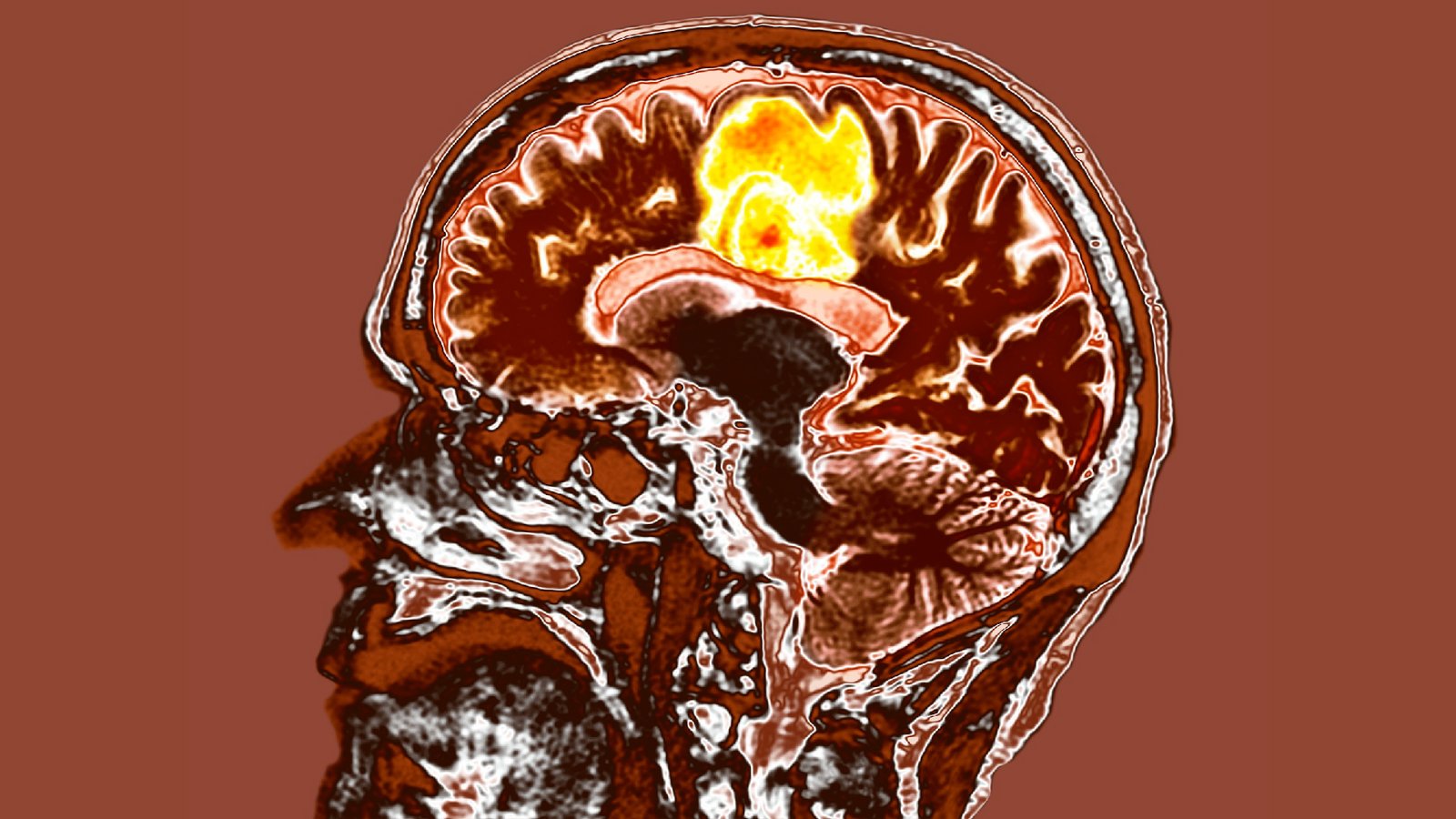 New treatment for most aggressive brain cancer may help patients